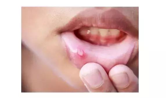 口腔溃疡需要补充维生素吗,舔口腔溃疡好得快吗