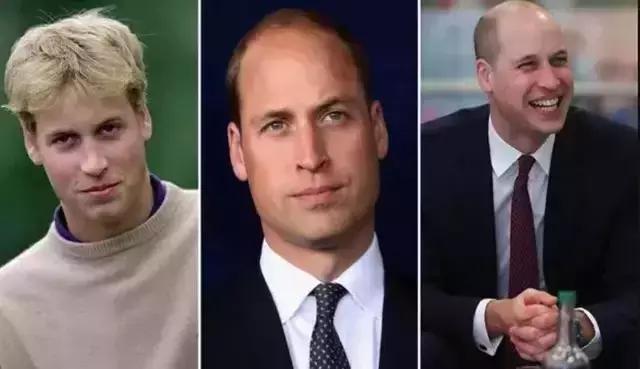 有许多明星脱发是怎样补救的,明星脱发都用什么方法