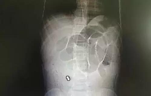 误食小玩具,小孩误食1厘米塑料玩具