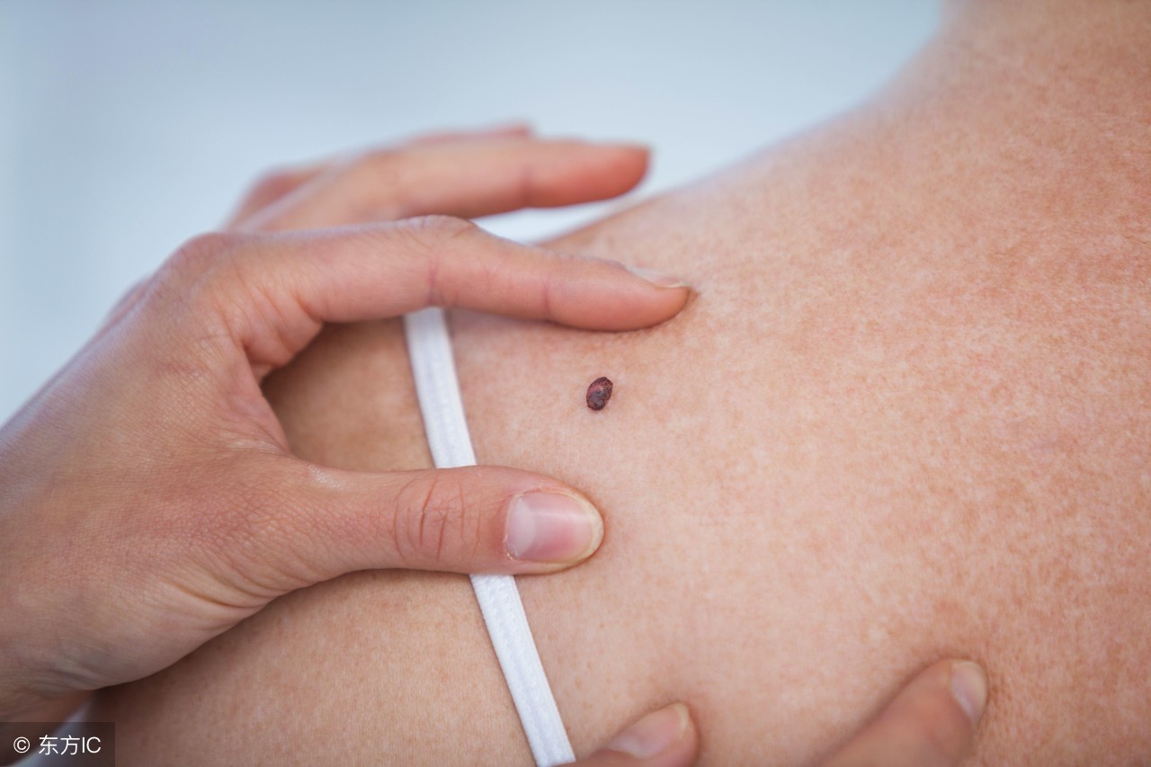 恶性黑色素瘤的病因与表现有哪些,黑色素瘤的发病原因和症状