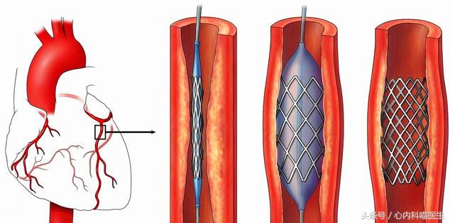长期药物治疗可以减轻冠状动脉狭窄、减少心绞痛和心梗发生
