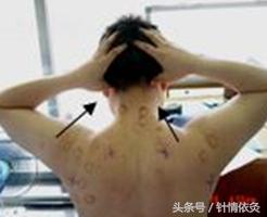 枕大神经痛可以针灸吗,枕大神经痛针灸好吗