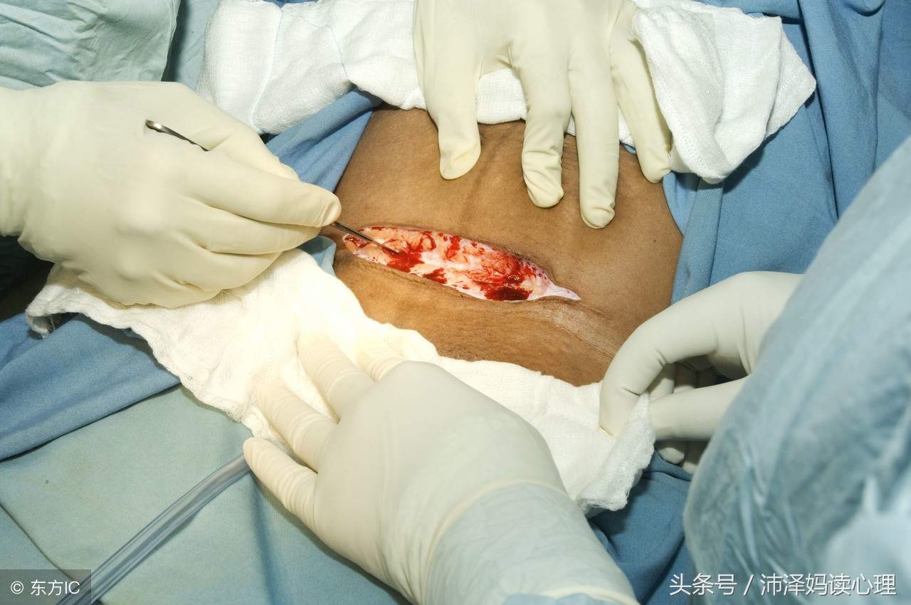 剖宫产与顺产最大区别,剖宫产和剖腹产的危险性