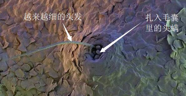 头发老掉是头皮有螨虫的原因吗,头发出油是螨虫的原因吗