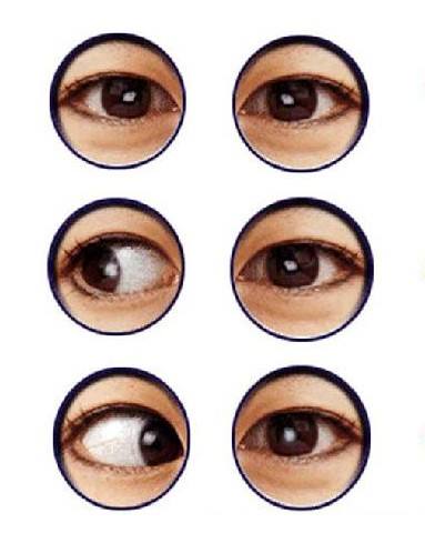 孩子高度近视引起的斜视弱视,小孩近视斜视弱视的区别