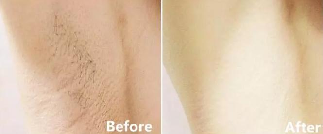 给毛裤脱毛,仙女脱毛最好的方法