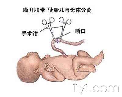 剖腹产,剖腹产3d动画演示