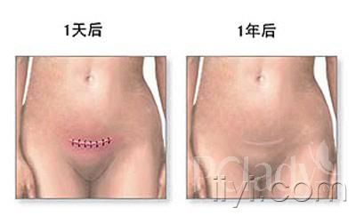 剖腹产,剖腹产3d动画演示