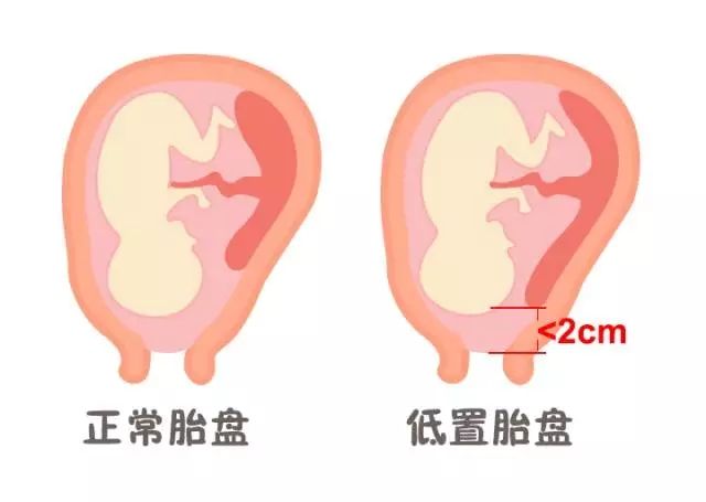 超声检查发现胎盘覆盖宫颈口，该怎么办？