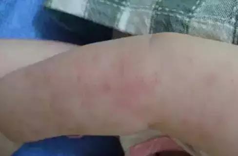 看看你是属于几级寒湿,人体寒湿