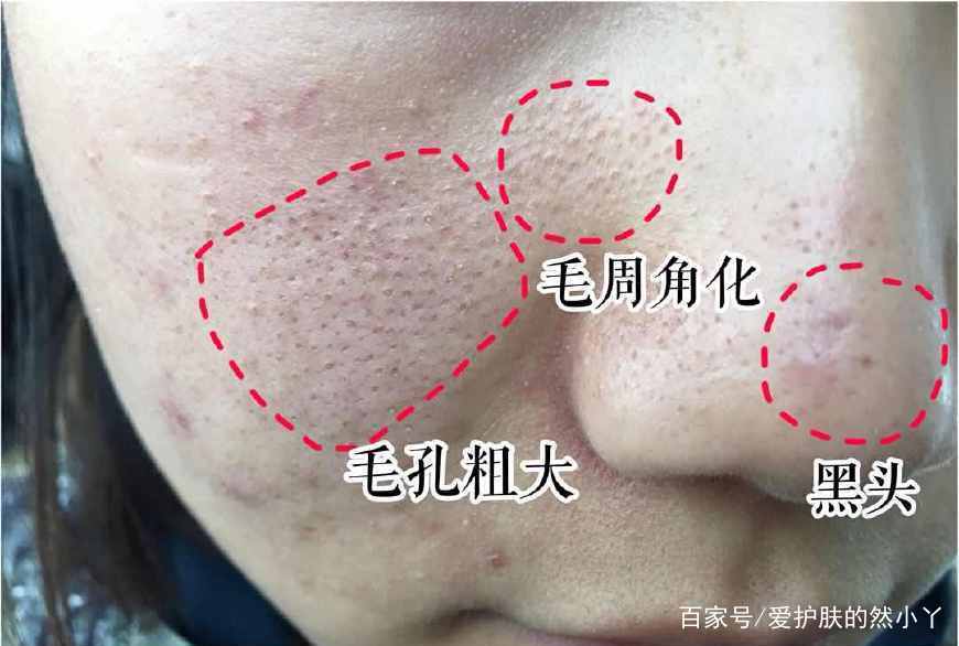 维生素b6乳膏可以收缩毛孔吗,收缩毛孔用维生素b6