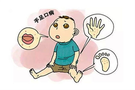 一旦发现宝宝得了手足口病怎么治,小孩得手足口病大人怎样预防