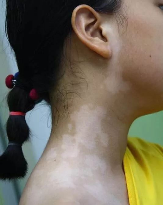 娃身上有好几处白斑,娃脸上有白斑是怎么回事