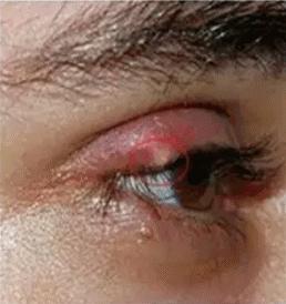 5岁小朋友长针眼,四岁孩子反复起针眼