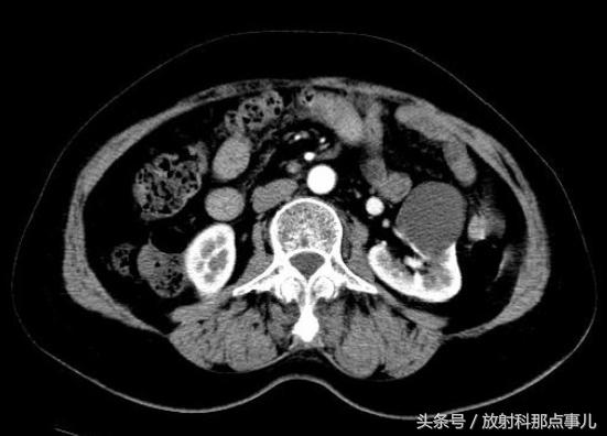 放射科医生带你认识肾囊肿、肾脏囊性肿块及应对策略