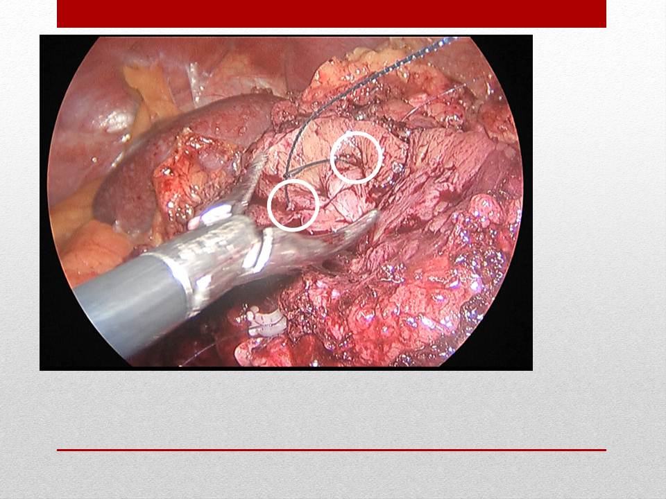 「图文+语音」刘明｜泌尿外科腹腔镜手术并发症的术中及术后处理