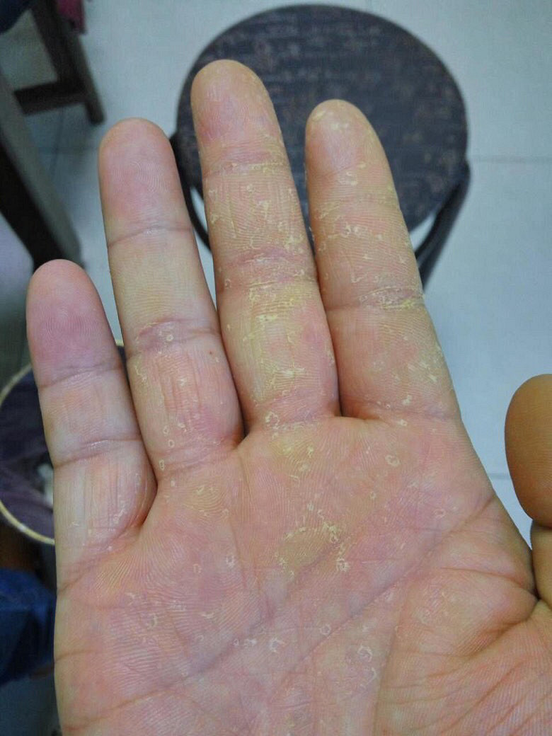 天气太冷长冻疮了怎么回事,关于天气冷到生冻疮