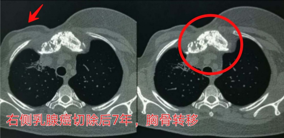癌症晚期带病长期生存,癌症患者的生存记录