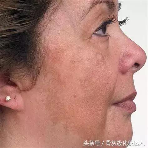 长了斑点怎么去除,长色斑怎么办5大方法祛除色斑