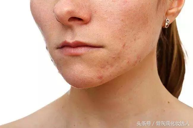 长了斑点怎么去除,长色斑怎么办5大方法祛除色斑