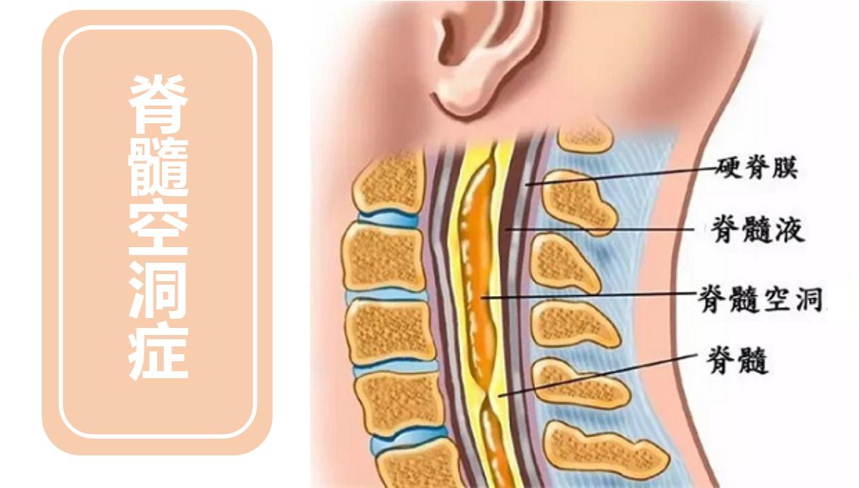 痛温觉障碍临床表现,脊髓损伤感觉障碍怎么治疗