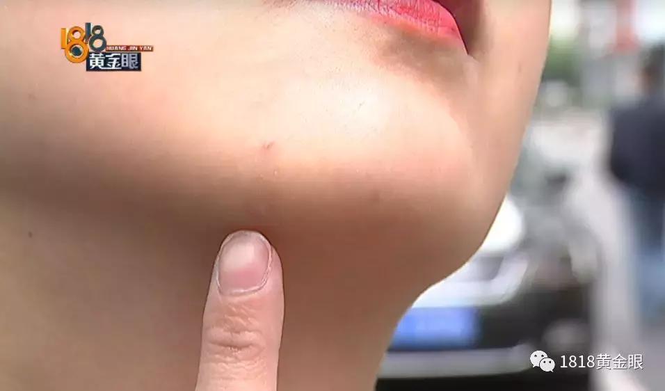 溶脂瘦脸4天了没有效果,花了1700打瘦脸针没效果