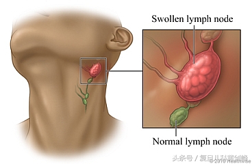 小孩脖子上摸到小疙瘩怎么回事,宝宝脖子上摸起来有疙瘩怎么回事