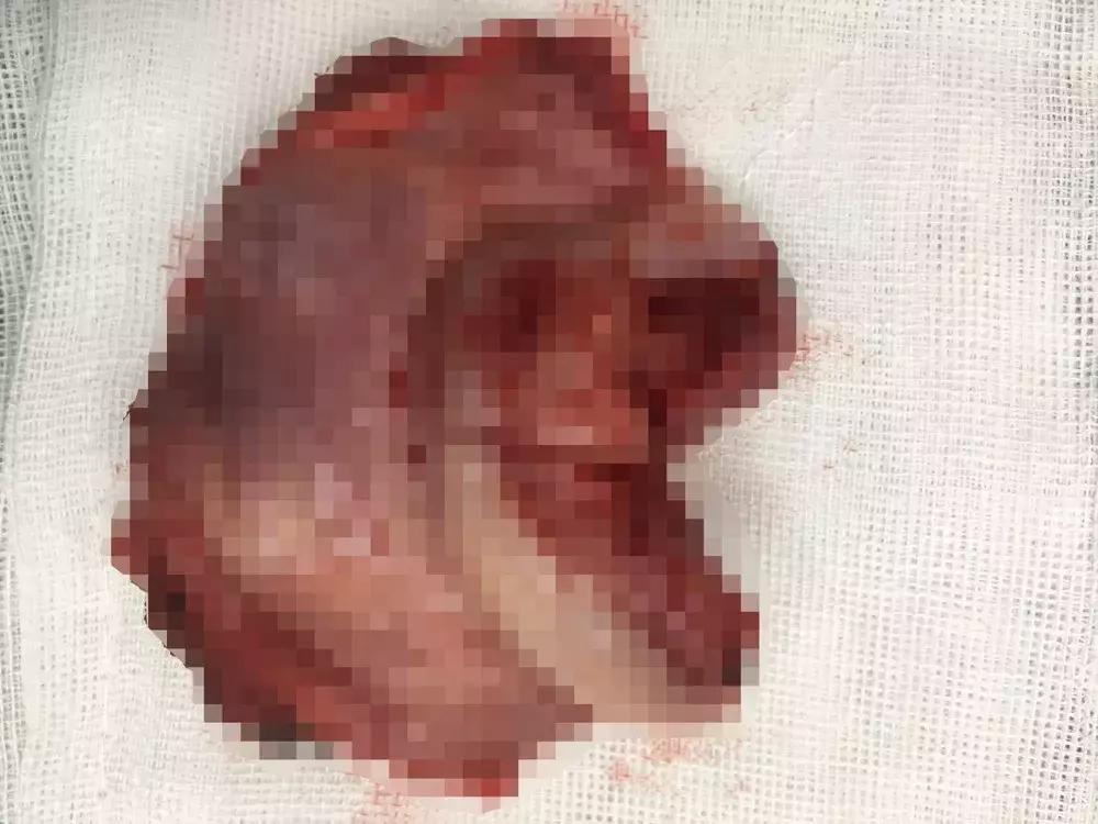 年轻未生育宫颈癌患者能否保留生育功能？