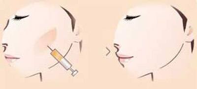 玻尿酸原液哪个牌子好,玻尿酸哪种好