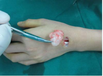 腱鞘囊肿有几种治疗方法,脚背上腱鞘囊肿怎么治疗