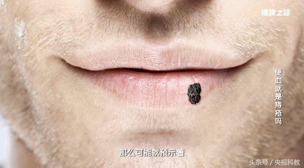 便血警惕六种病,便血最常见的原因及辨别方法