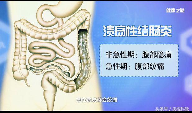 便血警惕六种病,便血最常见的原因及辨别方法