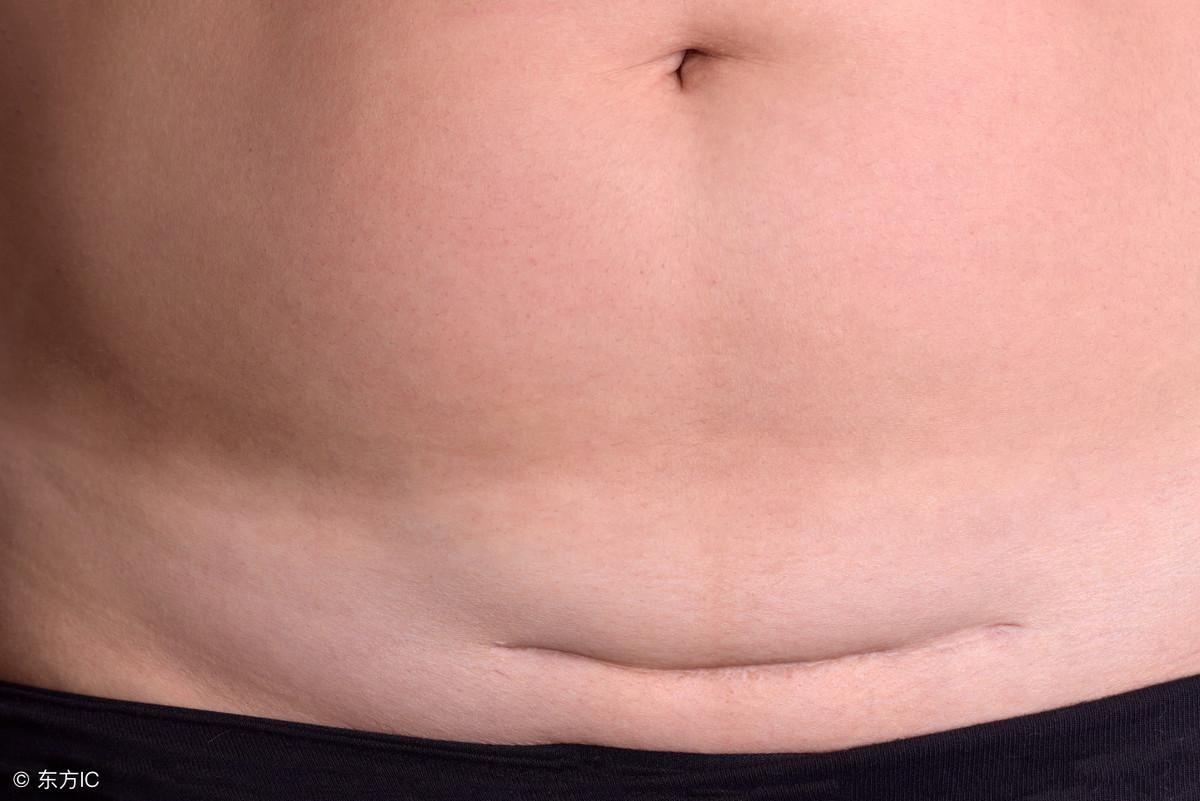 宫颈息肉摘除之后要注意什么,宫颈息肉摘除后注意事项是什么