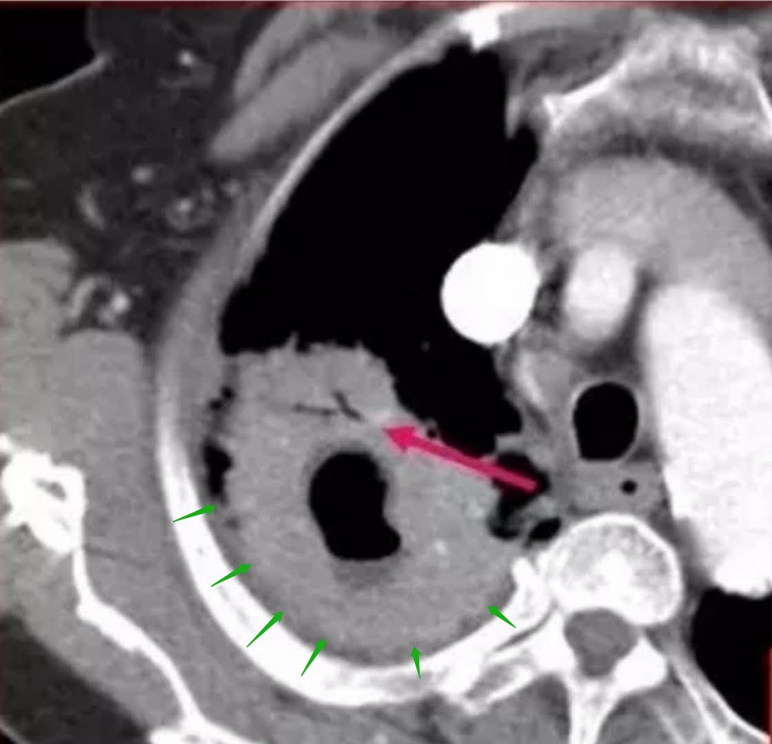 73岁老人肺上长3个结节有事吗,70多岁老人肺部有个拳头大的肿块