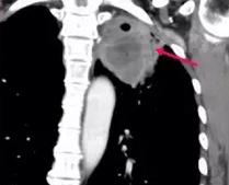 73岁老人肺上长3个结节有事吗,70多岁老人肺部有个拳头大的肿块