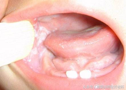 宝宝嘴巴里的奶块怎么去掉,宝宝嘴巴里有白色东西像奶瓣一样