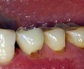 生活中常见的10大伤牙习惯,你中招了几个?