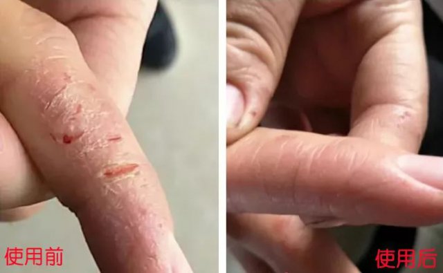 皮肤开裂使用护肤品多久自愈,泰国青草药膏能治皮肤干裂吗