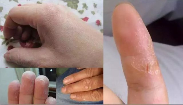 皮肤开裂使用护肤品多久自愈,泰国青草药膏能治皮肤干裂吗