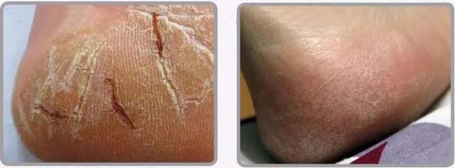 皮肤开裂使用护肤品多久自愈,泰国青草药膏能治皮肤干裂吗