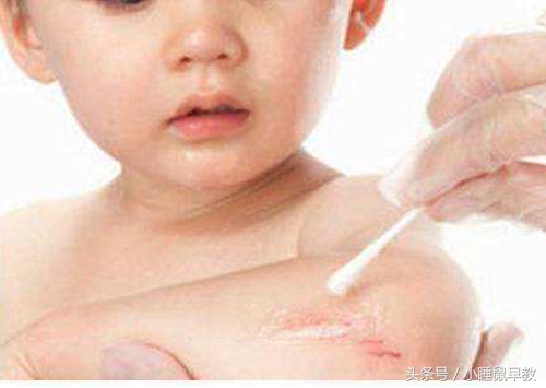 宝宝摔伤要怎么处理,宝宝摔伤怎么护理不留疤