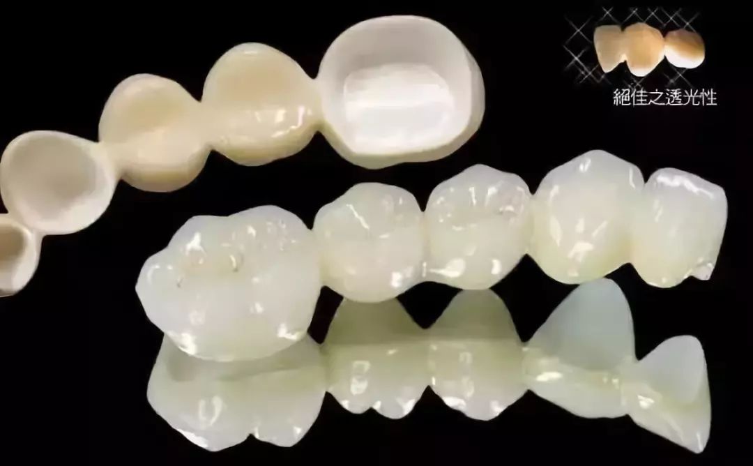 烤瓷牙与全瓷牙价格对比,烤瓷牙和全瓷牙价格差多少钱一颗