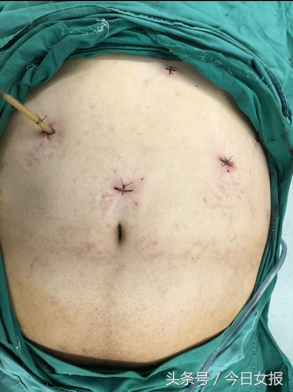 湖南第一胖,湖南最胖的人