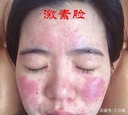 什么是激素脸激素脸要怎么治疗,激素脸是什么引起的怎么治疗
