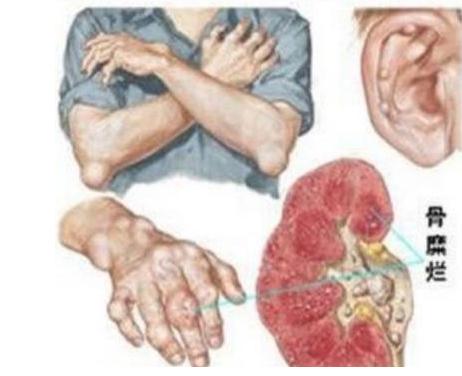 尿酸高的后果远不止痛风,警惕尿酸高的危害远不止痛风