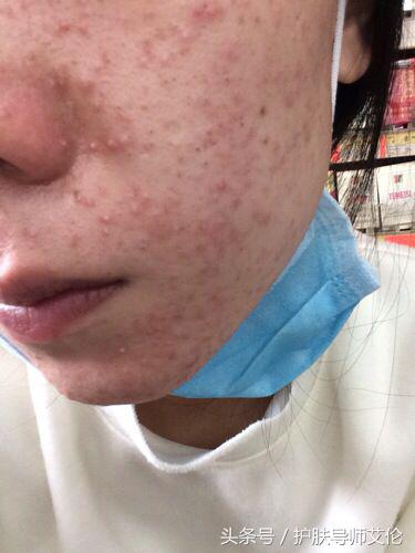 植物祛痘组合价格表,植物草本祛痘