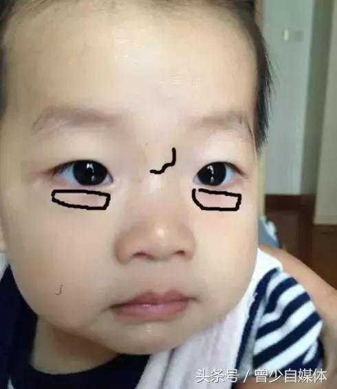 宝宝鼻梁有青筋真的比较难养吗,青筋难养鼻梁有青筋的宝宝