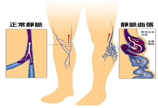 治疗静脉曲张最好最安全的办法,静脉曲张到底要怎么治疗才会根治
