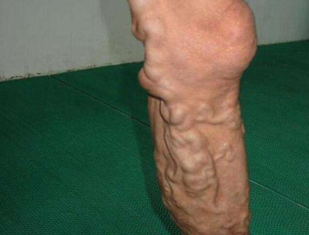 治疗静脉曲张最好最安全的办法,静脉曲张到底要怎么治疗才会根治