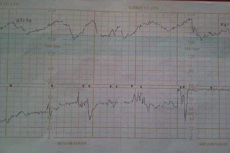 胎儿心跳超过160有危险吗,胎儿心跳过快是不是缺氧